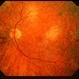 Possible Mellaril Toxicity